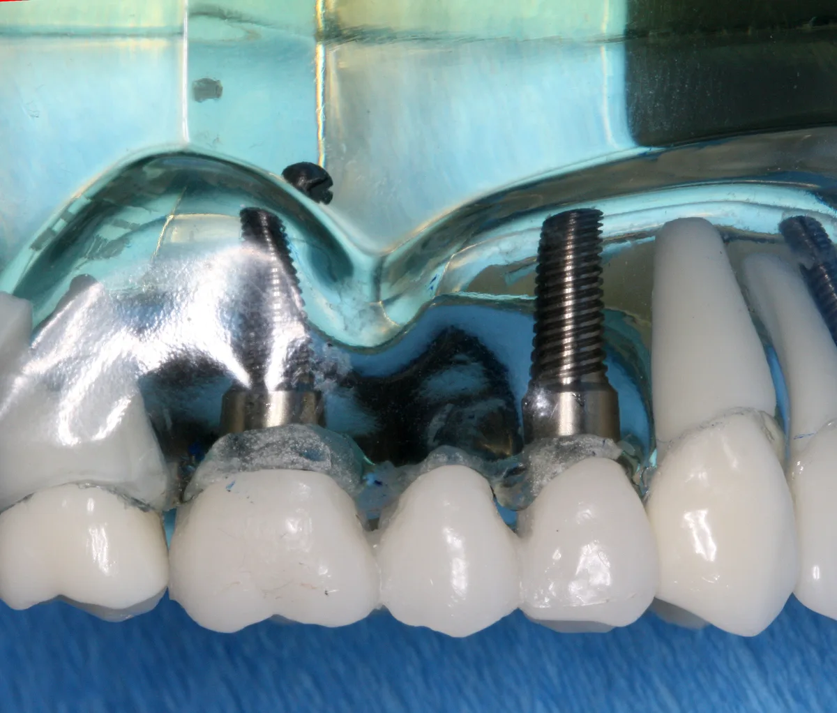 Demonstration model of a bridge supported by two dental implants